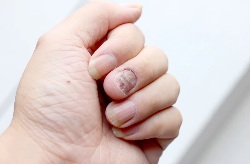 conclusion achieving healthy nails with the right onychomycosis treatments