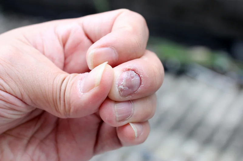 how does onychomycosis start