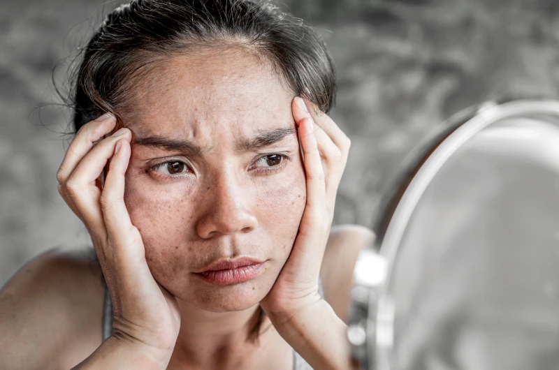 top medical treatments for melasma