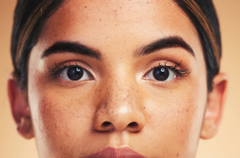 understanding the appearance of melasma