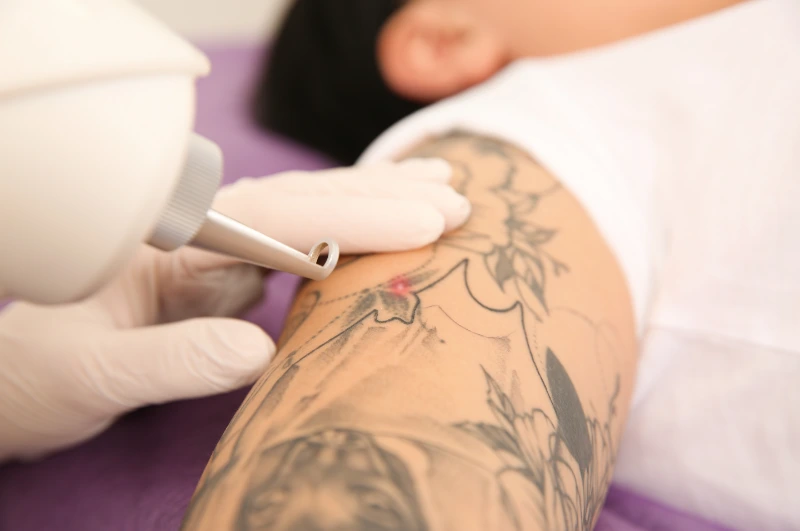 picoway laser treatment