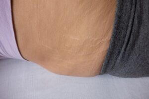 factors-influencing-the-development-of-stretch-marks