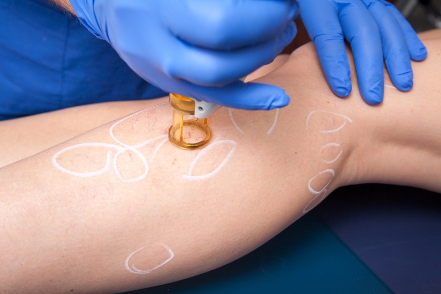what-are-the-causes-of-spider-veins
