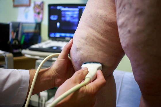 what-you-need-to-know-about-treating-varicose-veins
