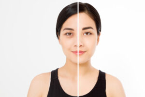 the-transformative-power-of-laser-under-eye-treatment