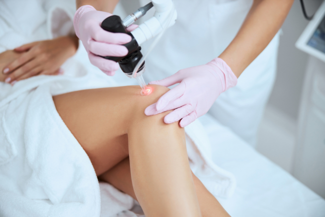 what-to-expect-during-laser-treatment-for-spider-veins