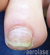 Laser Fungal Nail Removal Treatment