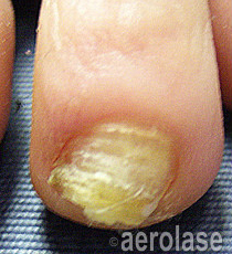 Laser Fungal Nail Removal Treatment