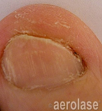 Laser Fungal Nail Removal Treatment