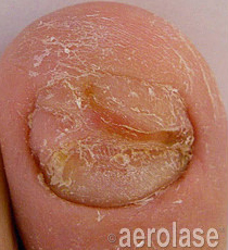 Laser Fungal Nail Removal Treatment