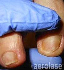 Laser Fungal Nail Removal Treatment