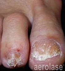 Laser Fungal Nail Removal Treatment