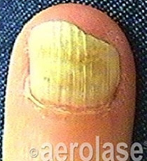 Laser Fungal Nail Removal Treatment