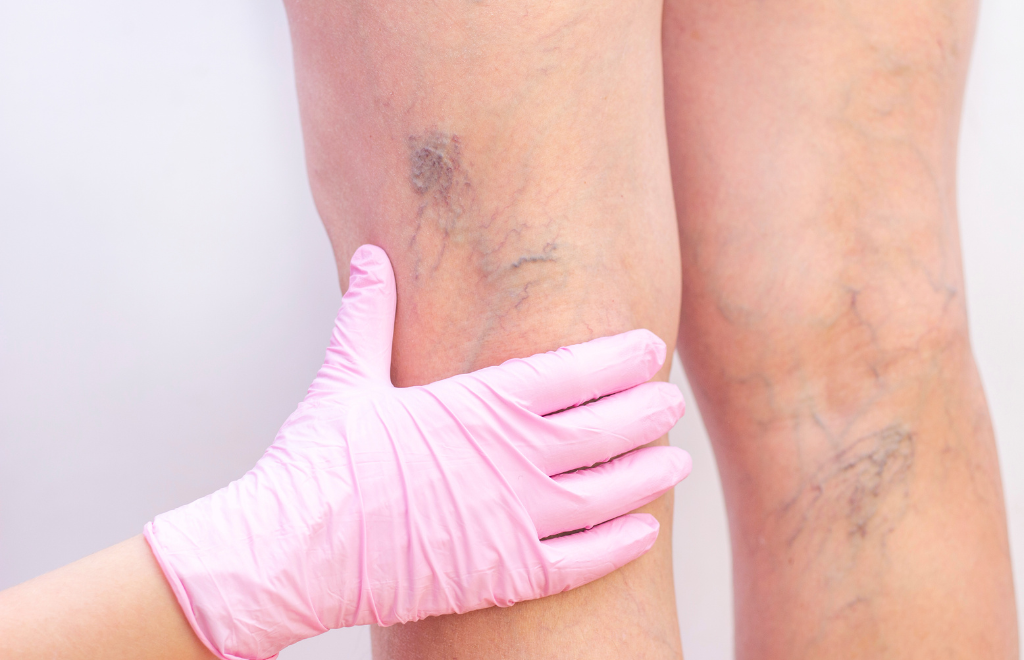 laser spider vein removal treatment initial evaluation