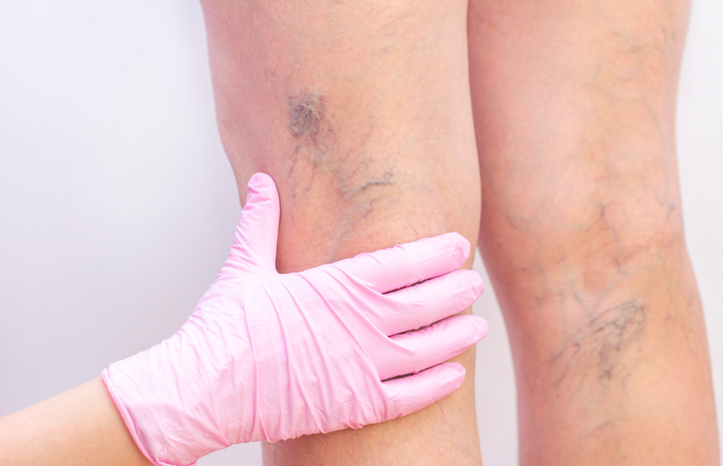 spider vein treatment initial evaluation