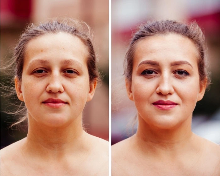 Botox for Frown Lines Before and After
