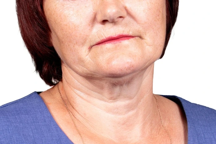 How to Get Rid of Neck wrinkles