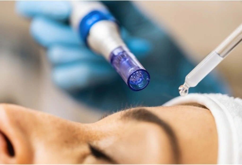 Microneedling vs Chemical Peel for Acne Scars