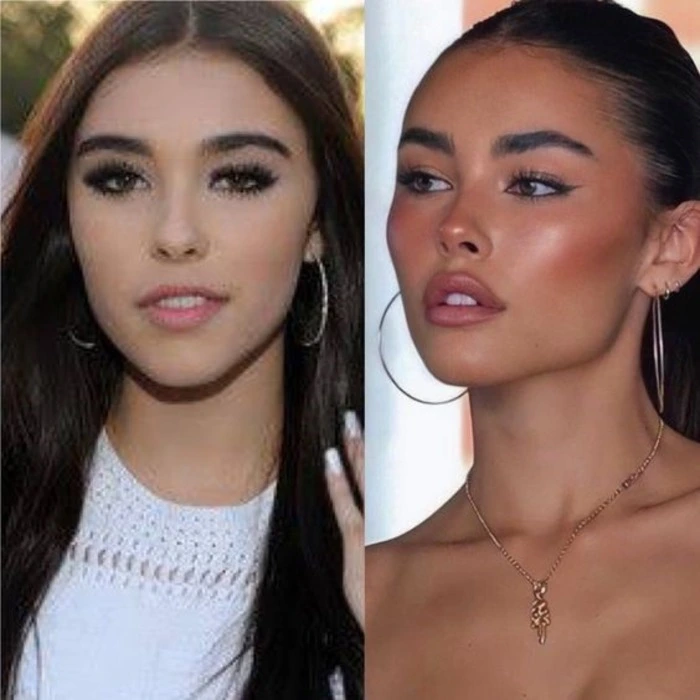 before and after fillers cheeks
