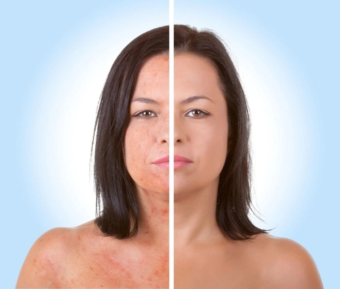 radiofrequency before after