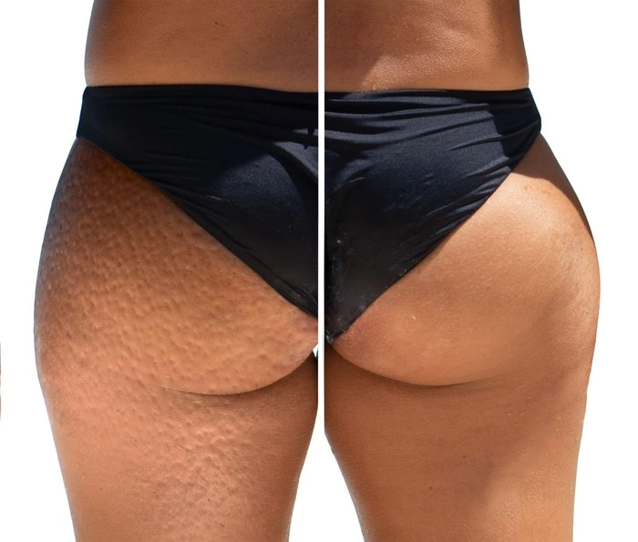 Cryolipolysis