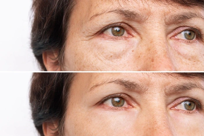 Differences Jeuveau vs Botox