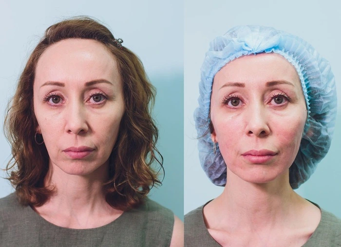 Jeuveau vs Botox Which is Better