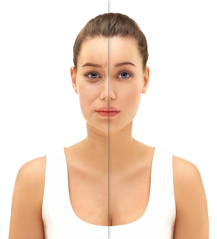 Marionette Line Filler before and after