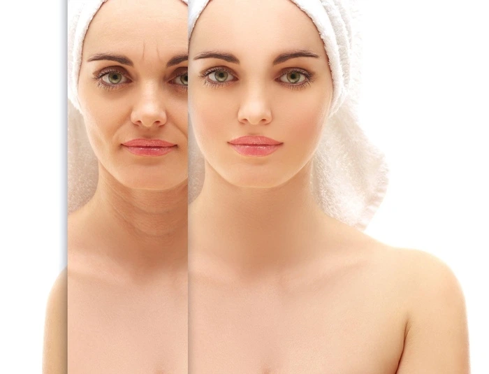 Understanding Marionette Lines Treatment