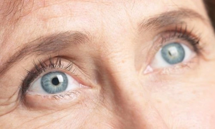 What is Botox for Crows Feet
