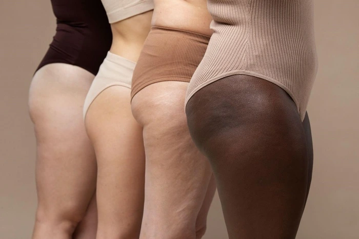 What is Cellulite
