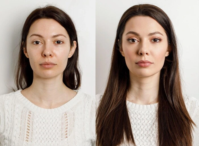 What is The Safest Dermal Filler