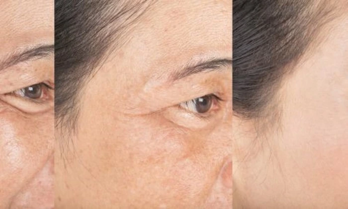 crows feet botox before and after