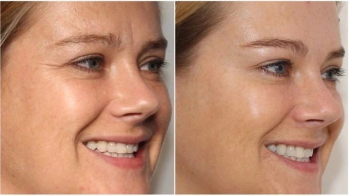 smile lines before and after
