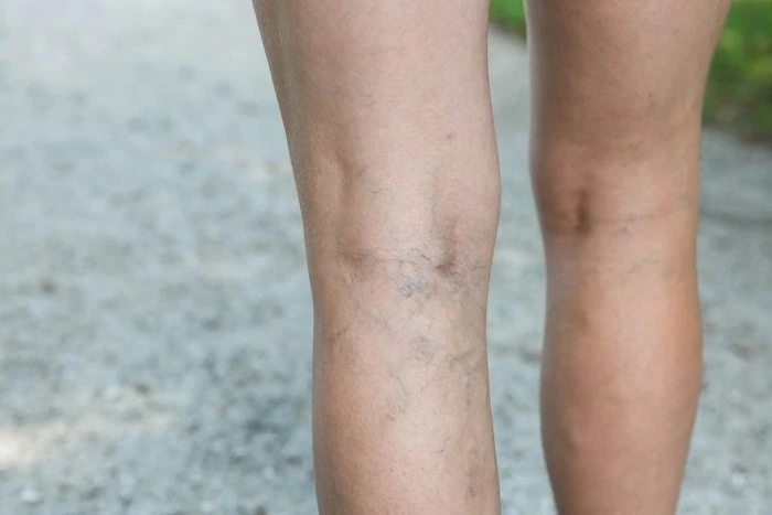 treatment for spider veins