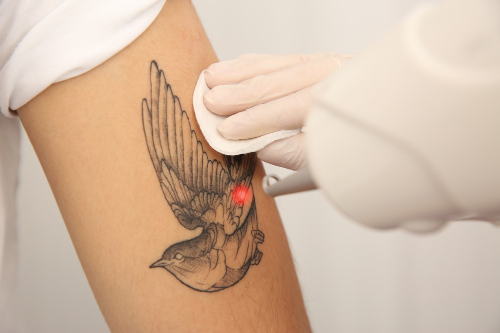 Picoway Laser Tattoo Removal Treatment in Los Angeles