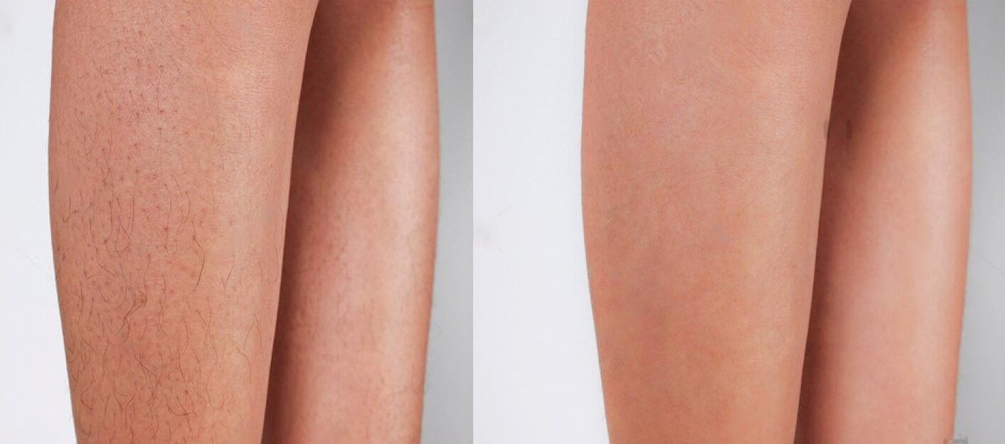 laser hair removal before and after legs