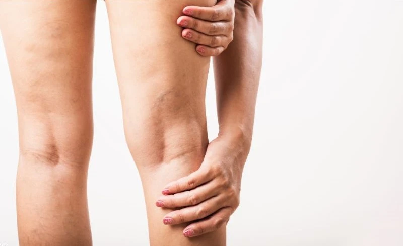 benefits of sclerotherapy