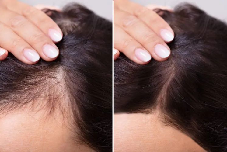 exosome therapy for hair fall reduction