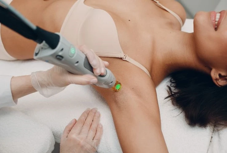 laser hair removal in los angeles