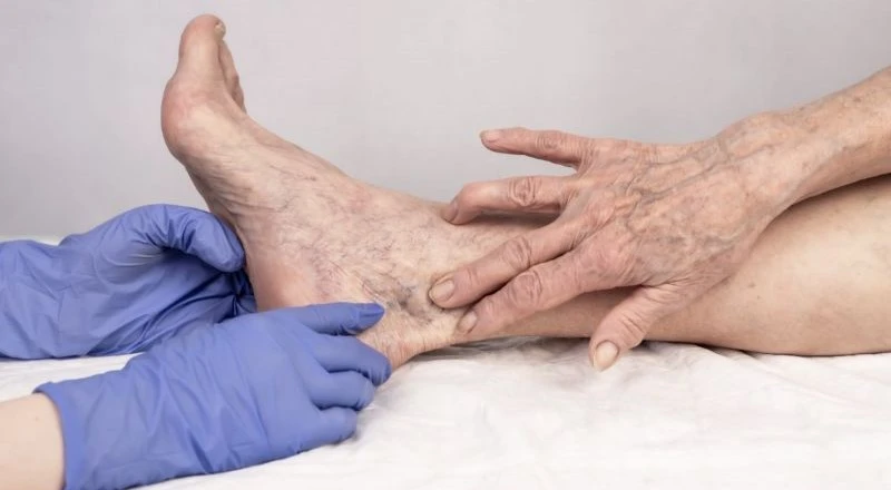 sclerotherapy process