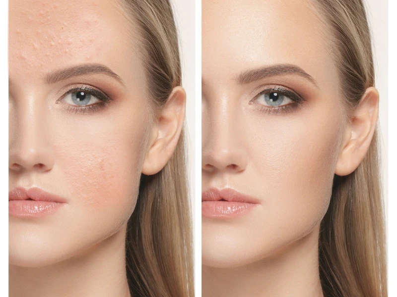 recovery and aftercare for laser skin resurfacing
