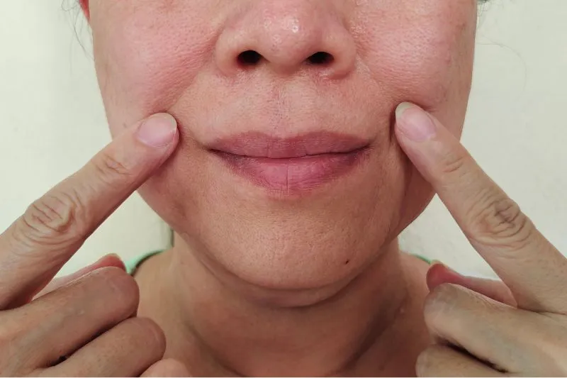 smile line fillers before and after results