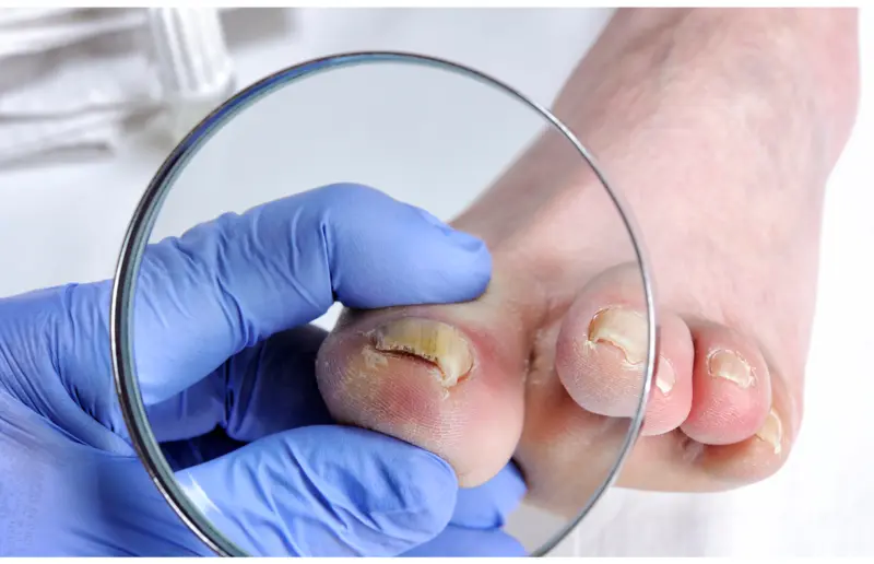 treating toenail fungus with laser