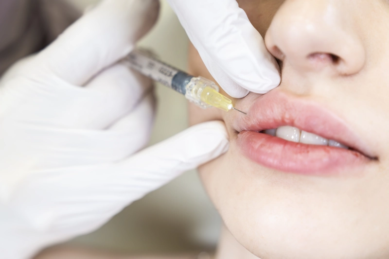Juvederm Fillers, Restylane Fillers