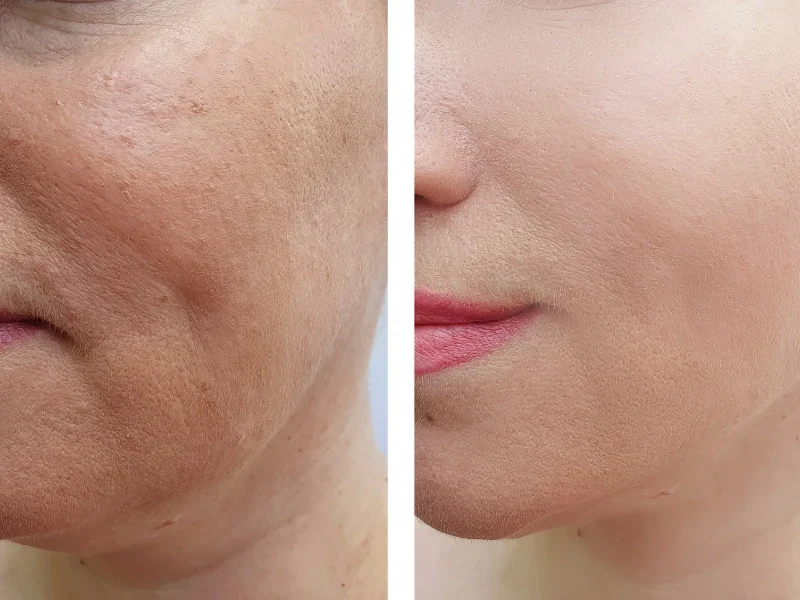 picoway resolve laser before and after​