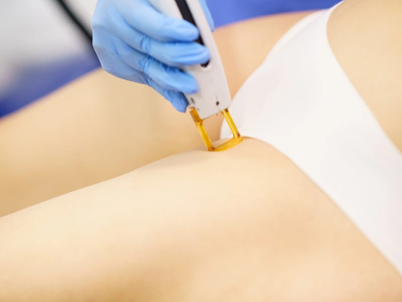Targeted Laser Hair Reduction