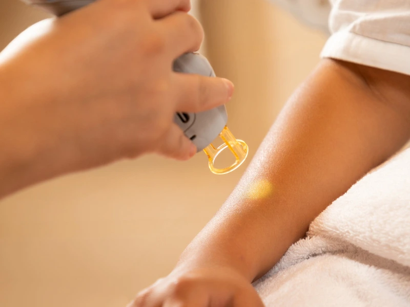 benefits Laser Hair Removal