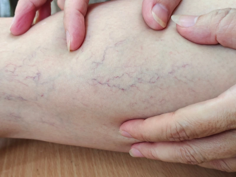 sclerotherapy cost​