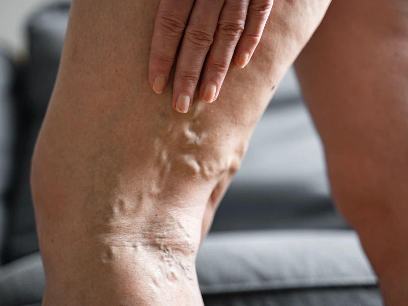 sclerotherapy recovery